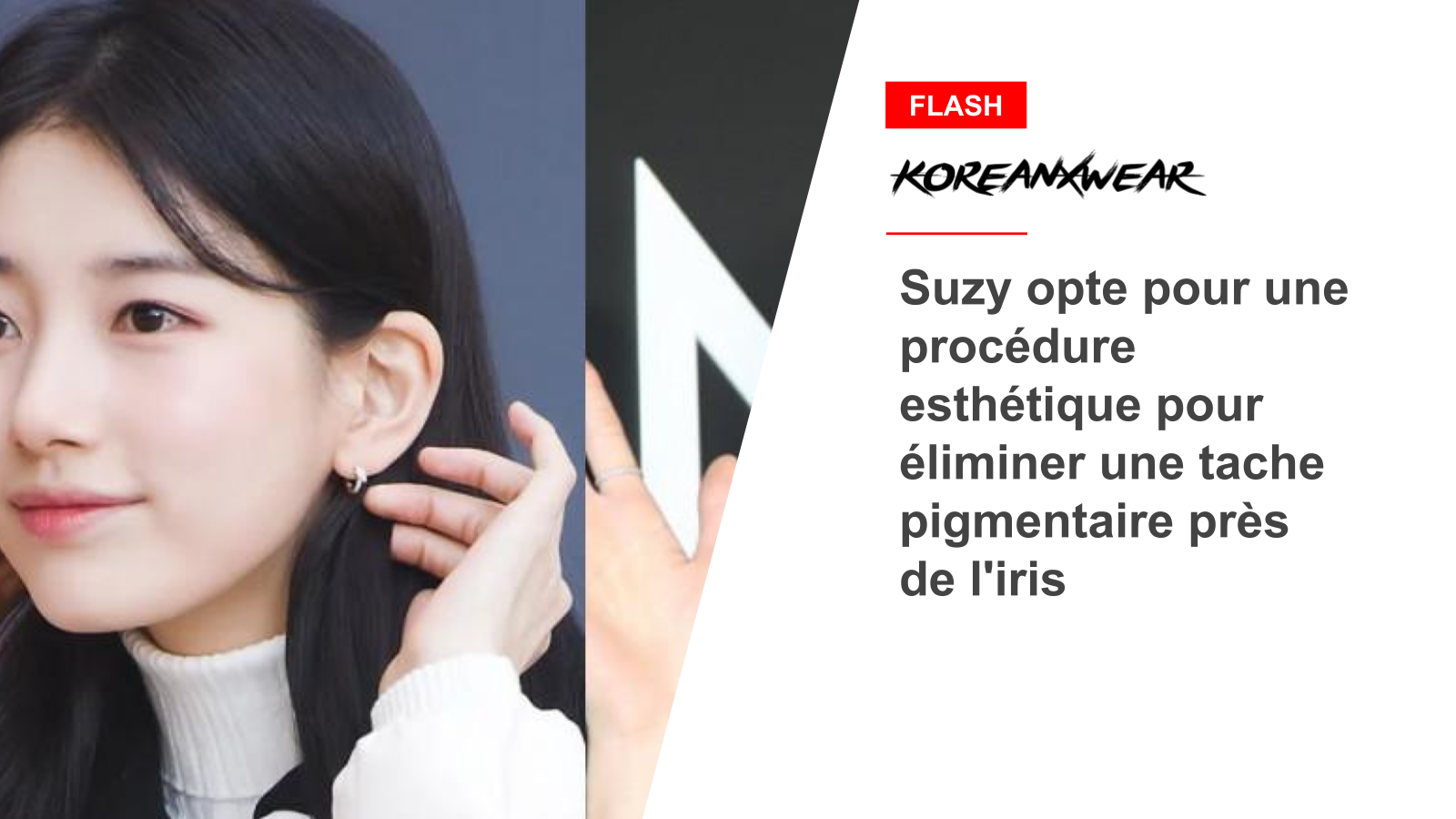 Suzy opts for a cosmetic procedure to remove a pigment spot near the iris